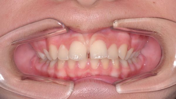 Ortodoncia Interceptiva y Aparatología Fija Multibrackets