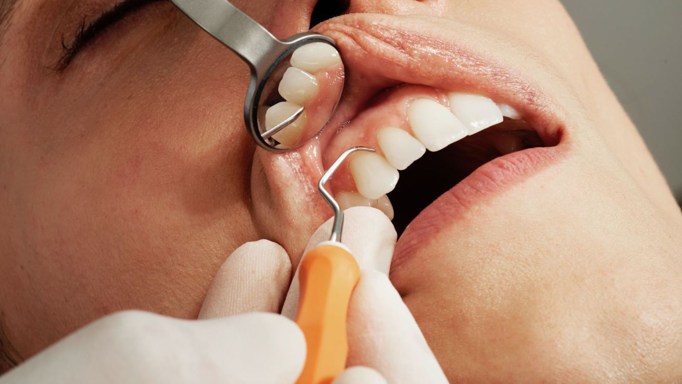 Tratamientos para la periodontitis y periimplantitis